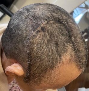 $4.8 Million Settlement Secured for Catastrophic Brain Injury - Panter ...