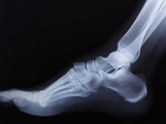 Broken Ankle Slip And Fall Miami Attorney